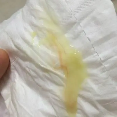 为什么会突然掉一坨白带出来 白带多是说明身体不好吗--小麦知识
