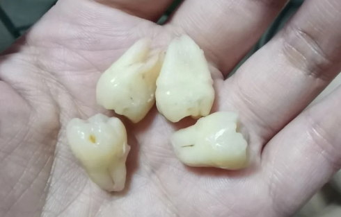 为什么有的牙齿有2个牙根有的没有 有两个牙根的是什么牙-小麦知识