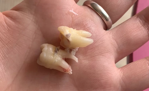 为什么有的牙齿有2个牙根有的没有 有两个牙根的是什么牙-小麦知识