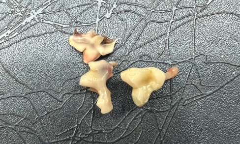 拔牙血凝块要保护几天 拔牙血凝块掉了还能重新凝结吗-小麦知识