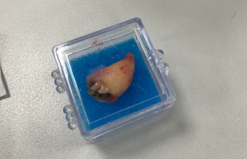 拔牙血凝块要保护几天 拔牙血凝块掉了还能重新凝结吗-小麦知识