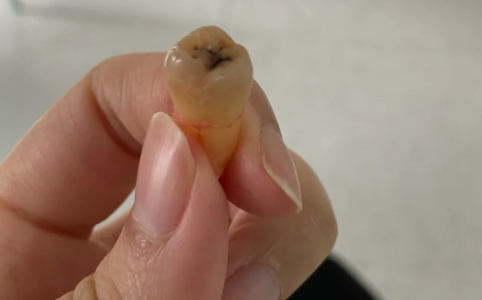 血凝块掉了一定会得干槽症吗 拔牙多久能排除干槽症-小麦知识