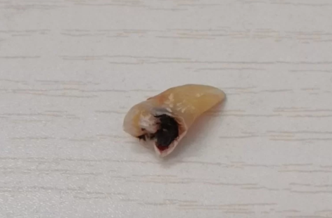 第二天血凝块掉了没事吧 拔牙后喝粥把血凝块喝没了怎么办-小麦知识