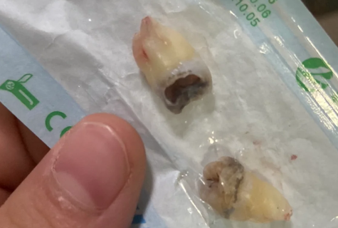 第二天血凝块掉了没事吧 拔牙后喝粥把血凝块喝没了怎么办-小麦知识