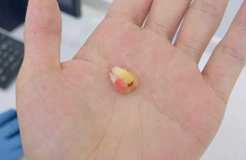 智齿烂了一个洞很痛怎么办 智齿烂了一定要拔吗-小麦知识