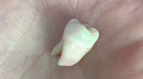 智齿烂了一个洞很痛怎么办 智齿烂了一定要拔吗-小麦知识