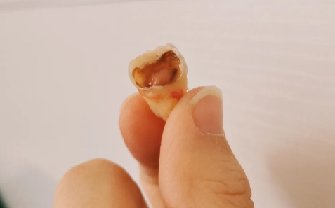 拔牙第三天为什么疼的又厉害了 拔牙第三天为什么叫高峰期-小麦知识