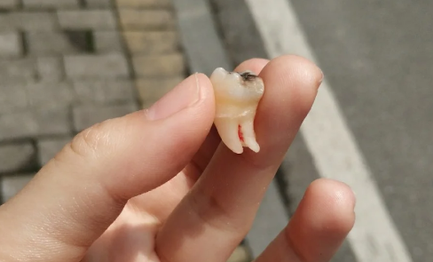 拔了一颗大牙后悔死了什么说法 大牙烂了只剩一点空壳了怎么办-小麦知识