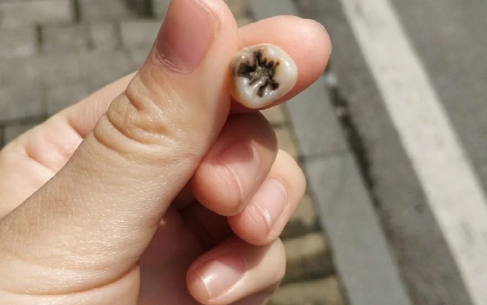 拔了一颗大牙后悔死了什么说法 大牙烂了只剩一点空壳了怎么办-小麦知识