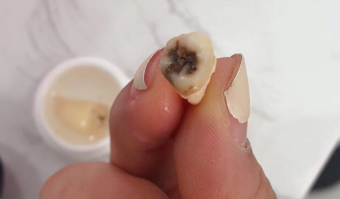 拔了一颗大牙后悔死了什么说法 大牙烂了只剩一点空壳了怎么办-小麦知识