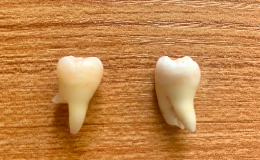 拔牙后棉球吐掉还出血需要再咬棉球吗 拔牙后棉球吐掉还出血可以不管吗-小麦知识
