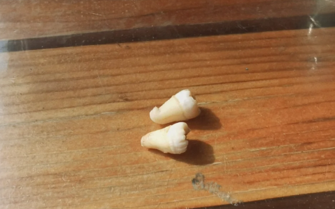 拔完智齿为啥三四天最疼 拔完智齿三四天冰敷还是热敷-小麦知识