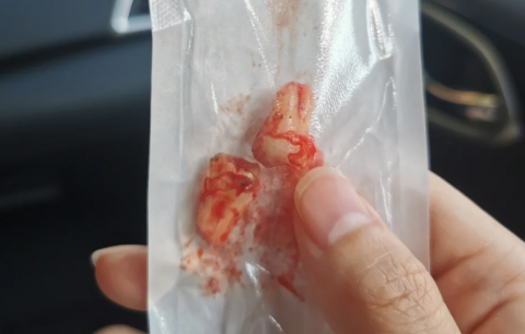 拔完智齿为啥三四天最疼 拔完智齿三四天冰敷还是热敷-小麦知识