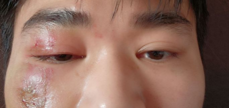 隐翅虫疤痕色素半年还没好 隐翅虫留下的色素痕怎么去除-小麦知识