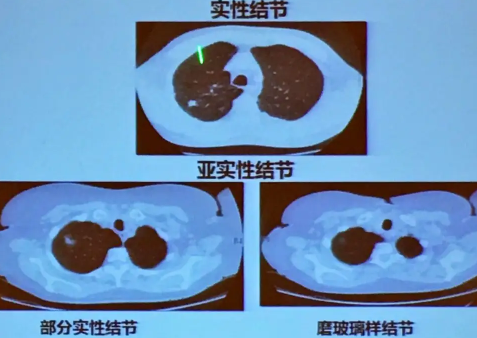 肺结节吓坏了多少年轻人 肺结节要随访一辈子吗-小麦知识