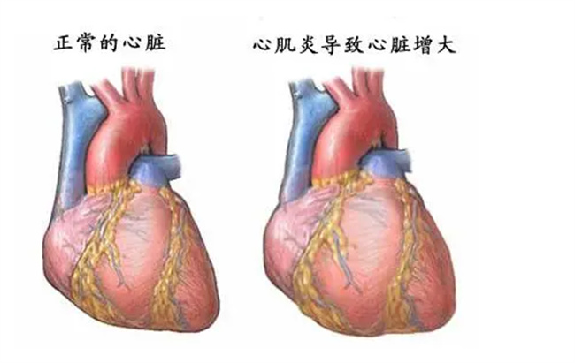 病毒性心肌炎是什么病 什么是病毒性心肌炎-小麦知识