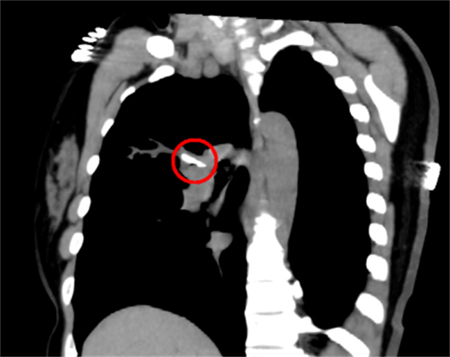 “肺要咳出来”要拍CT吗？ “肺也要咳出来”要不要拍CT-小麦知识